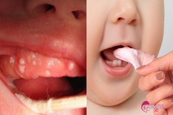 Vệ sinh răng miệng cho trẻ khi bị mọc nanh sữa