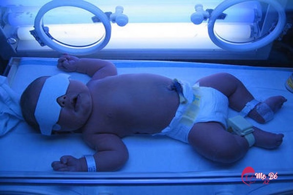 Chữa vàng da cho trẻ so sinh bằng phương pháp chiếu đèn