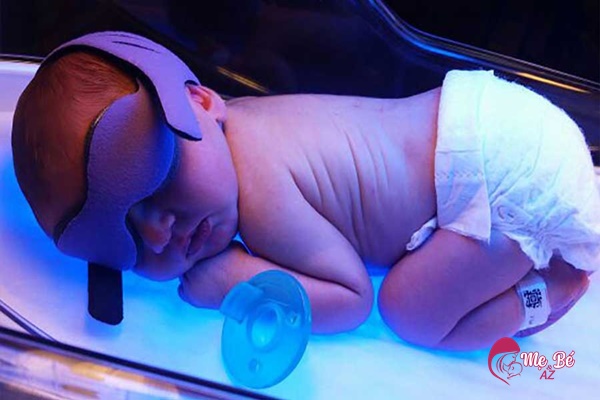 Trẻ sơ sinh bị vàng da chiếu đèn trong ba lâu phụ thuộc vào tình trạng nặng nhẹ ở trẻ