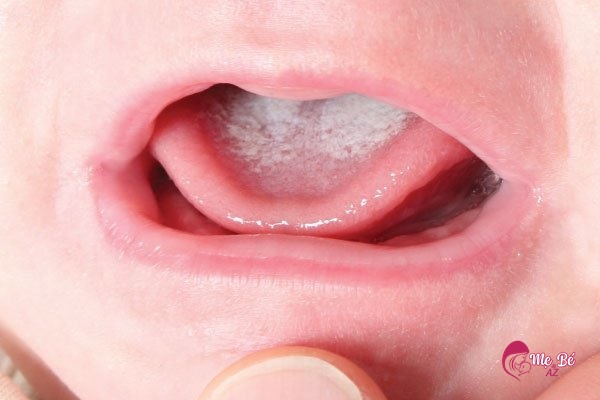 Trẻ sơ sinh bị trắng lưỡi là hiện tượng không hề hiếm gặp