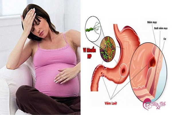 Mẹ bầu rất dễ bị đau dạ dày khi mang thai
