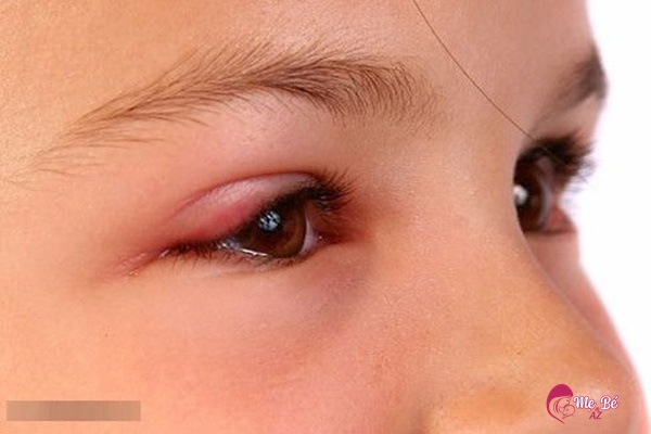 Tại sao trẻ 2 tuổi bị đổ ghèn ở mắt?