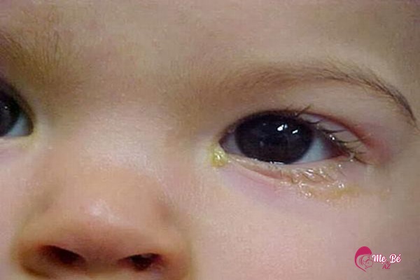 Các mẹ giải đáp câu hỏi: Trẻ 2 tuổi bị đổ ghèn ở mắt