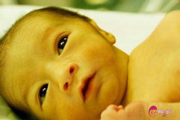Vàng da là hiện tượng khá phổ biến ở trẻ sơ sinh